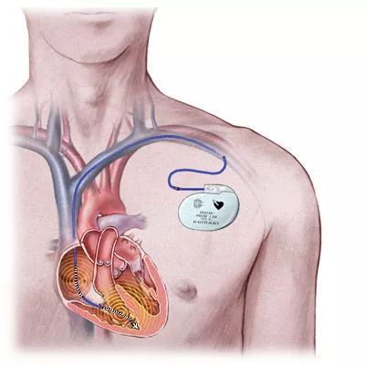 体检报告中的“早搏”是心脏病吗？需不需要治疗？